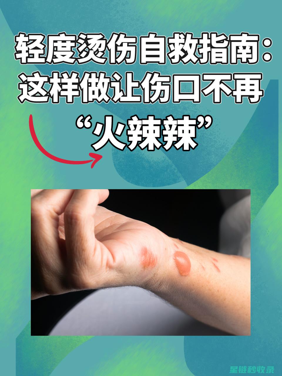 轻微烫伤：急救处理与预防复发的全面指南 (轻微烫伤急救)